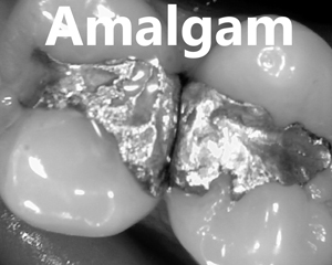 mercury amalgam filling